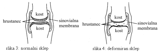 Deformacija sklepa Sinovitis